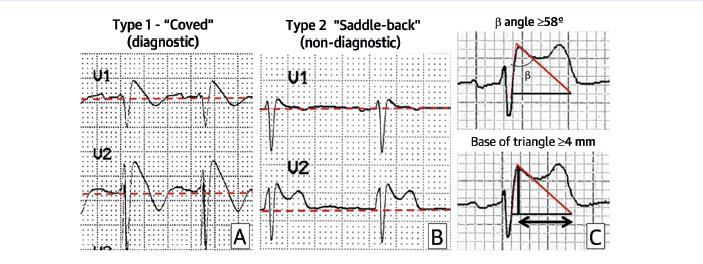 BrS: Diagnosis Spontaneous Type I BrS ECG Type I BrS ECG after provocative test + 1: documented VF/VT syncope