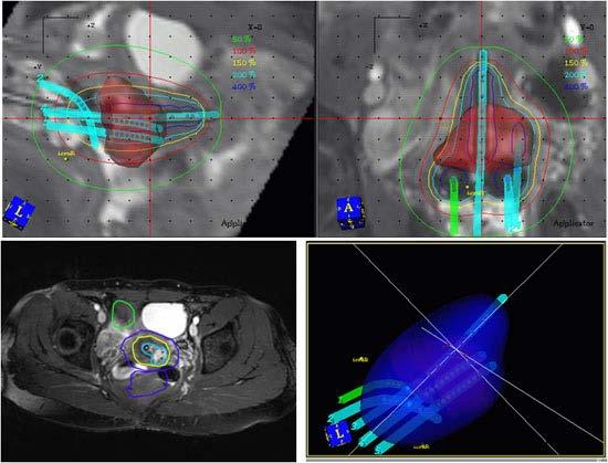Brachytherapy Indications: Mainly: Gynaecology (HDR and PDR) Prostate Cancer