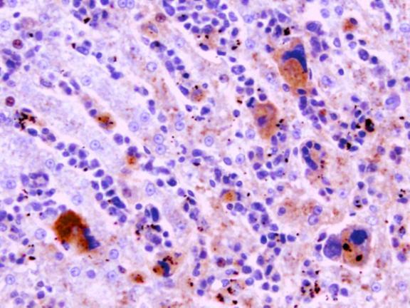 Figure 9 Histologic section of liver stained with CD61 (platelet glycoprotein IIIa) positive cells.