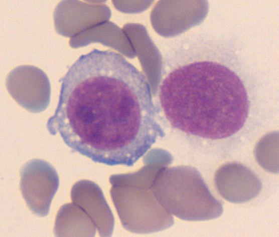 Figures Figure 1 Peripheral blood smear with a large blast cell and a lysed cell.