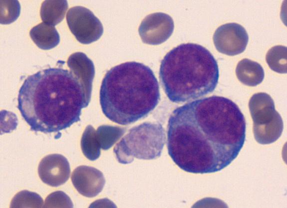 Figure 2 Peripheral blood smear with 4 large blast cells and a large cytoplasmic fragment.