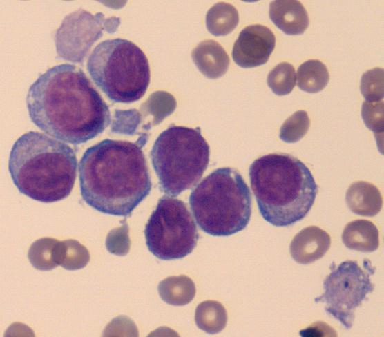 Figure 3 Peripheral blood smear with 8 blast cells and 2 large cytoplasmic fragments (giant platelets).