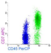 11 Case MRD (351) Case MRD (351) Primitive markers: +, +, 3+ Case MRD (351) Case MRD (351) Myeloid markers: +, but - (aberrant) Aberrant markers: CD22(low) Small