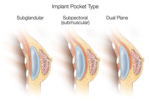 Implant Placement Implants may be placed 1.