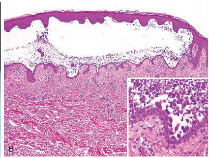 Pemphigus vulgaris Suprabasal separation resulting in intraepidermal blister Mucosal epithelium is also involved 4