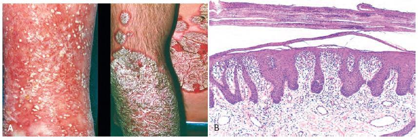 Psoriasis Salmon-colored lesions covered by silver-white scales -Any age, more in hormonal changes (puberty & menopause, but improves in pregnancy) -Autoimmune, multifactorial (genetic &