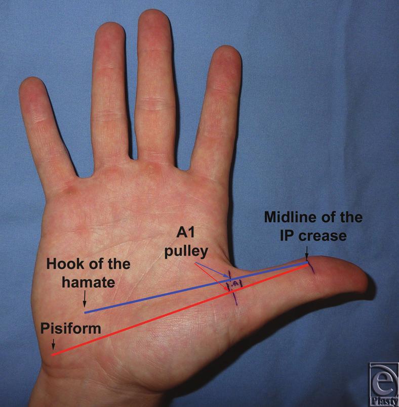 eplasty VOLUME 10 Figure 1. Proposed longitudinal anatomic landmarks for the thumb A1 pulley: the midline of the thumb interphalangeal (IP) crease, the hook of the hamate, and the pisiform.