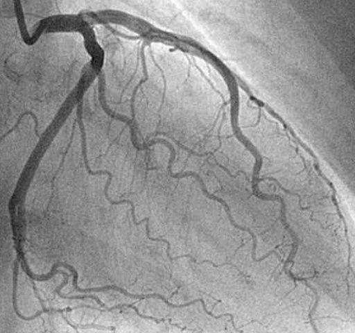 Coronary angiogram. A coronary angiogram, acquired with an X-Ray C-arm system.