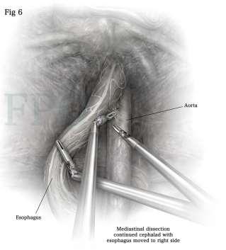 GPEH: Mediastinal Dissection Karush &