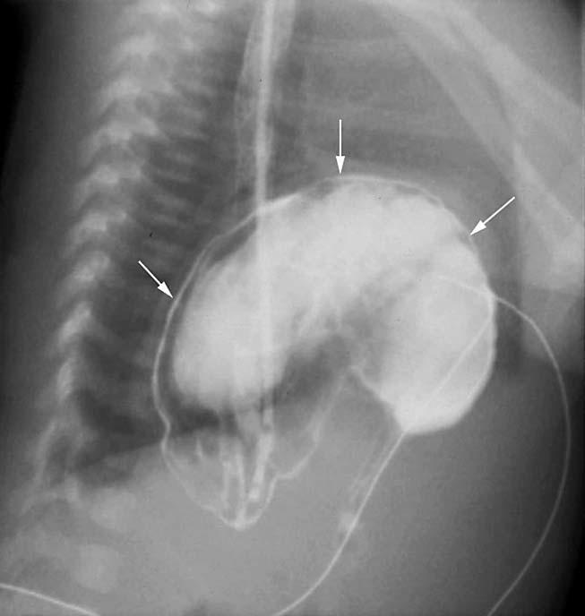 Plain radiograph of chest and abdomen -> Left diaphragmatic elevation -> Gastric air shadow in left chest -> Dilated oesophagus ->