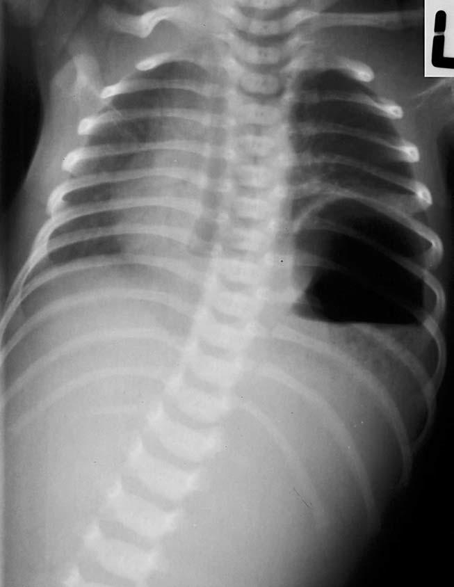 Upside down stomach with reversal of greater and lesser curvatures - Greater curvature (white arrows) crossing the esophagus - Gastric