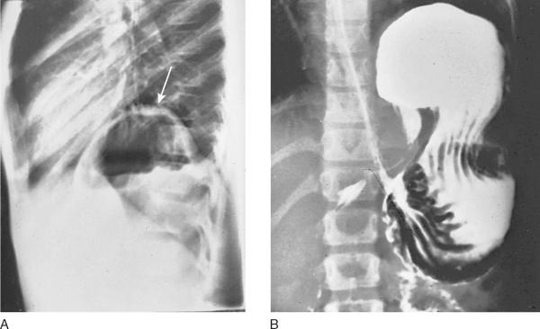 A -> Lateral chest radiograph - Elevation of the left diaphragm (arrow) B -> Frontal radiograph: upper GI series - Gastroesophageal junction: normal to slightly low in position - Pylorus superior and