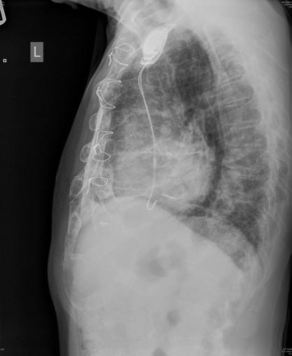 Pulmonary Fibrosis C.