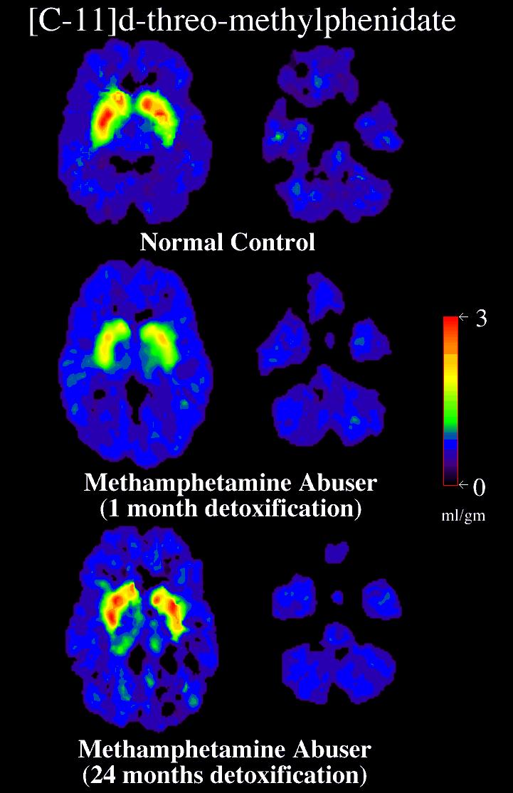 [C-11]d-threo-methylphenidate DAT Recovery with prolonged abstinence from methamphetamine Normal Control