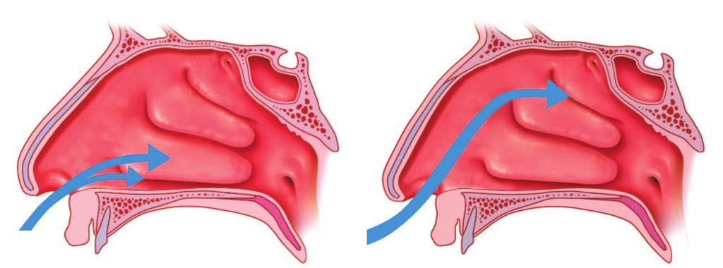 nasal valve must also be addressed. To restore proper airway flow dynamics, the tip needs to be cephalically rotated. This can be accomplished utilizing the technique described below.