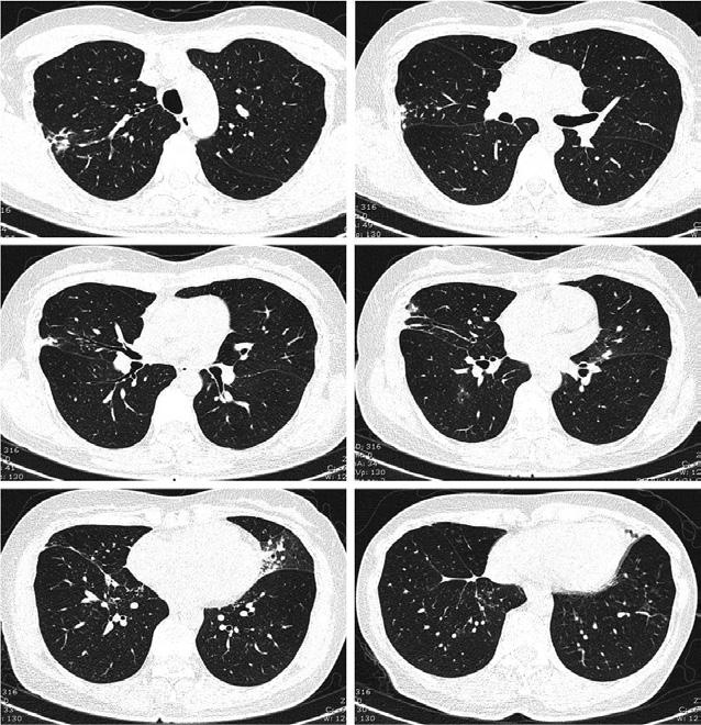 Answer 3 The CT scan of the thorax showed fibroreticular opacities in the right upper lobe, middle lobe and apical part of the right lower lobe.