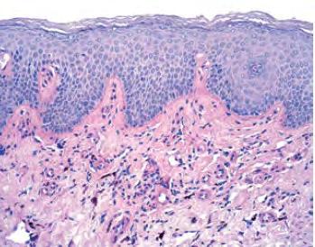 Histology of Early LS