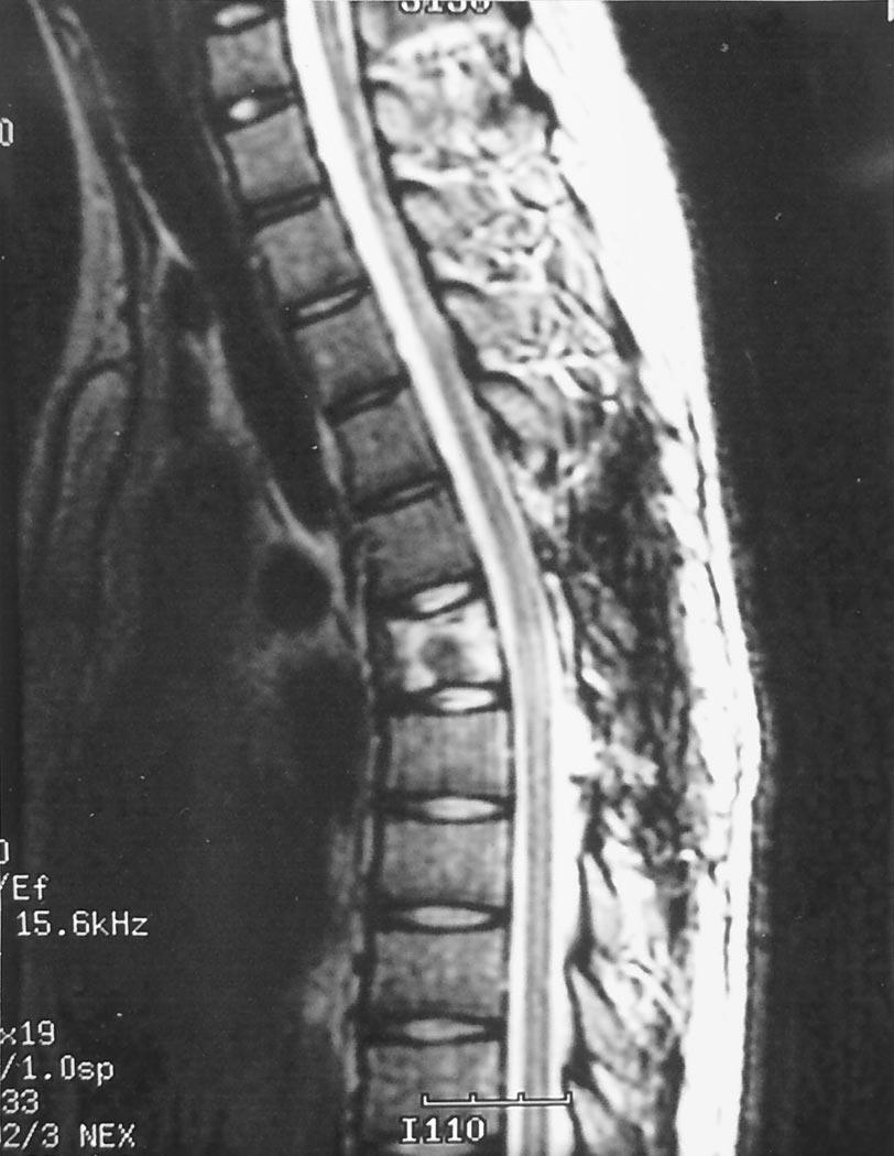 E330 Spine Volume 27 Number 13 2002 Figure 1. T2-weighted sagittal magnetic resonance image showing an increase in intensity in the T6 body when the patient first came for treatment in March 1997.