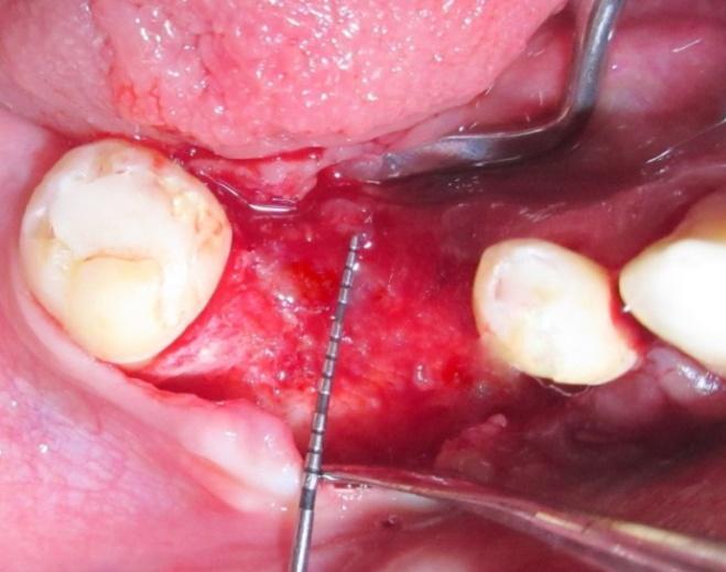placement of oral implants when ridge deformities are present. The present case provides a clinical description of the use of titanium mesh along with bone graft for bone reconstruction.