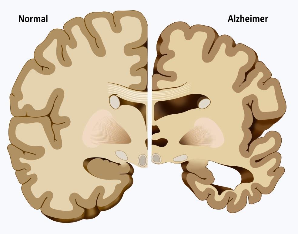Late life 30% OF ALZHEIMER CASES DUE TO