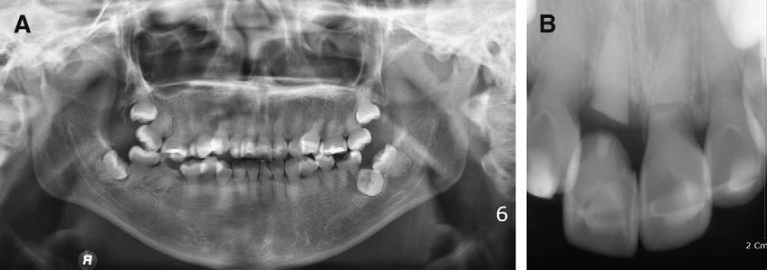 354 Roh, Kang, and Kim American Journal of Orthodontics and Dentofacial Orthopedics September 2010 Fig 2. Pretreatment dental casts. Fig 3.