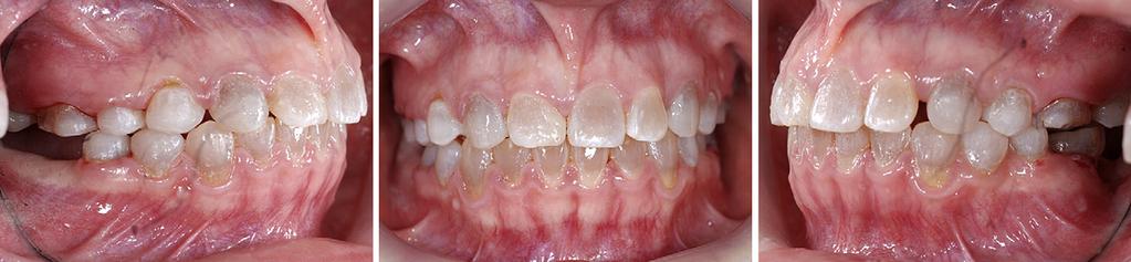 American Journal of Orthodontics and Dentofacial Orthopedics Roh, Kang, and Kim 357 Volume 138, Number 3 Fig 7.