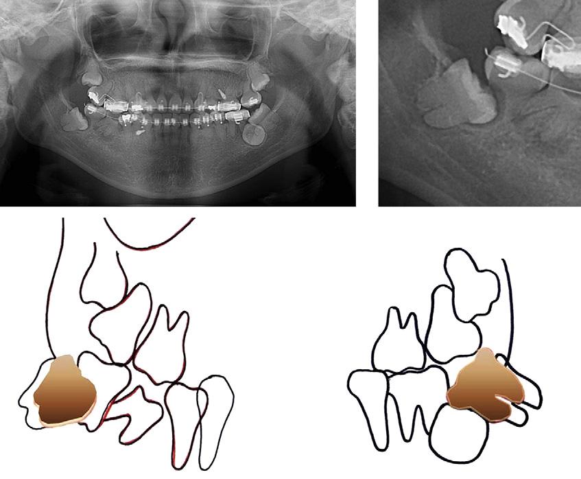 Superimposition with pretreatment panoramic radiograph shows progressive eruption of the remaining third molars. Fig 8. Intraoral photographs after debonding.