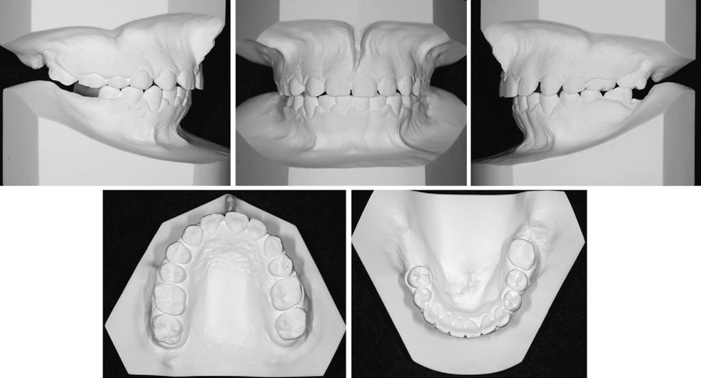 358 Roh, Kang, and Kim American Journal of Orthodontics and Dentofacial Orthopedics September 2010 Fig 9. Dental casts after debonding. Fig 10. Intraoral photographs of the maxillary anterior region.