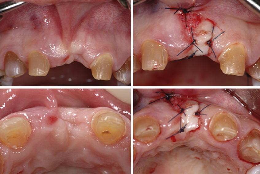CONCLUSIONS This report focused on the importance of a multidisciplinary approach and specific orthodontic considerations for the successful treatment of a patient with DI.