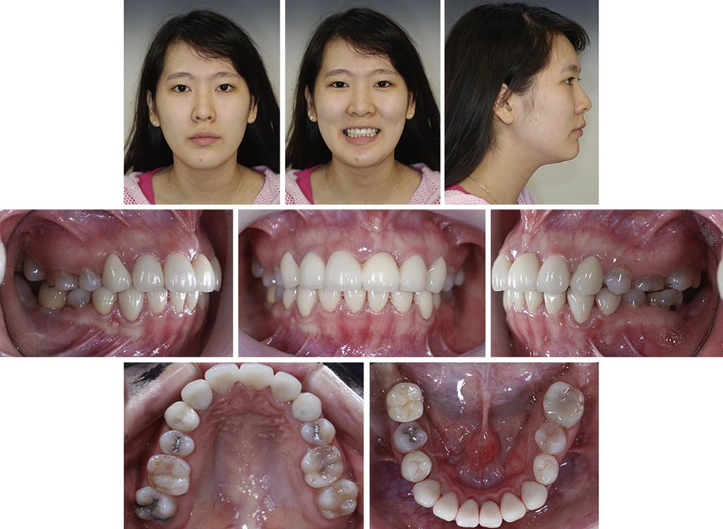 American Journal of Orthodontics and Dentofacial Orthopedics Roh, Kang, and Kim 359