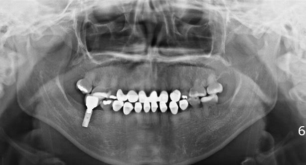 360 Roh, Kang, and Kim American Journal of Orthodontics and Dentofacial Orthopedics September 2010 Table II.