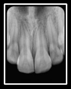 Enamel Fracture Clinical Findings Radiographic Findings Treatment A complete fracture of the enamel. Loss of enamel. No visible sign of exposed dentin. Not tender.