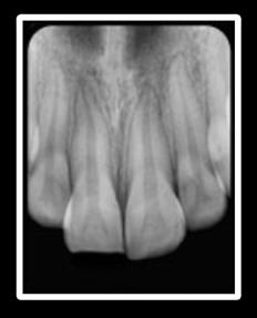 Enamel -Dentin Fracture Clinical Findings Radiographic Findings Treatment A fracture confined to enamel and dentin with loss of tooth structure, but not exposing the pulp. Percussion test: not tender.