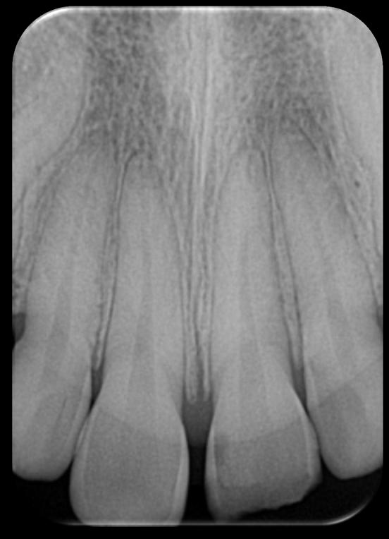 Enamel -Dentin Fracture 15