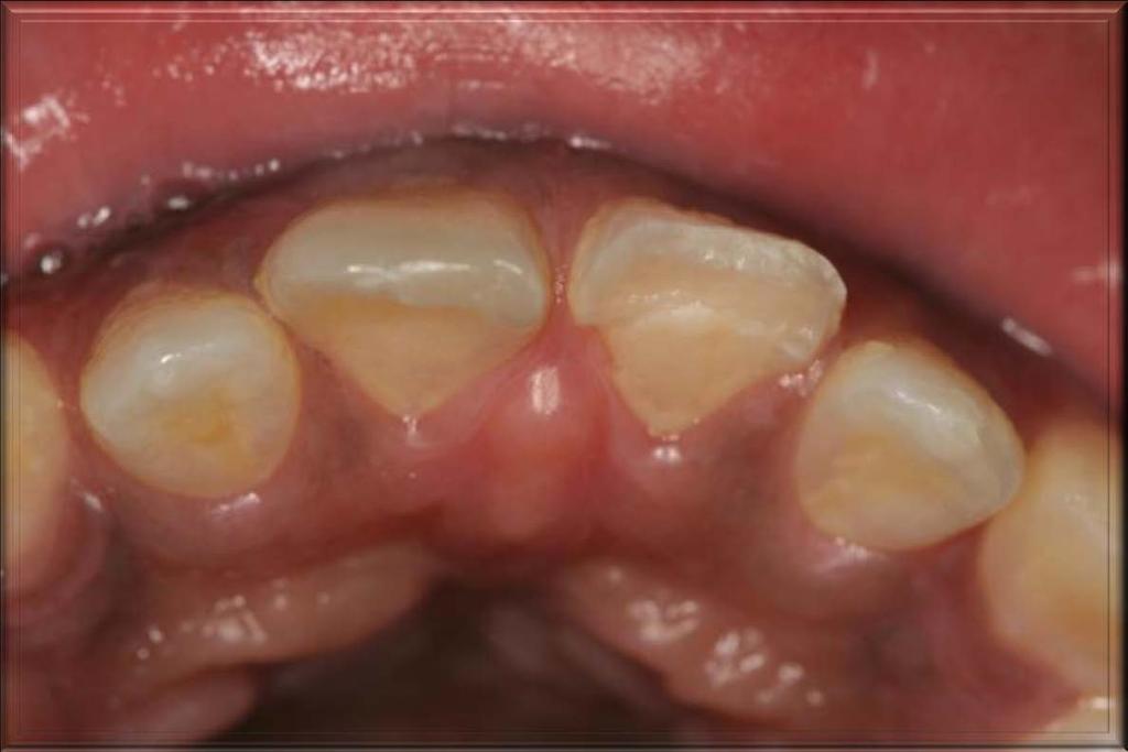 Enamel -Dentin Fracture