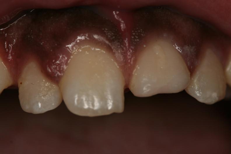 Enamel -Dentin