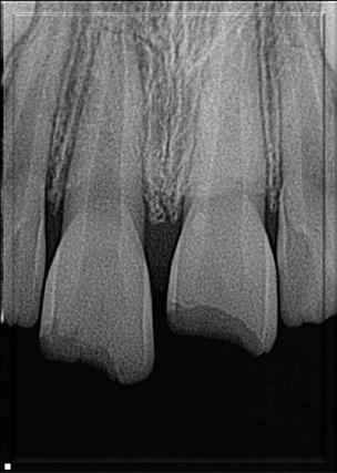 Enamel -Dentin Fracture Diagnosis: Extrusion tooth # 8 Crown-fracture uncomplicated teeth # 8 and 9 Treatment (extrusion): 1. Reposition as soon as possible 2.