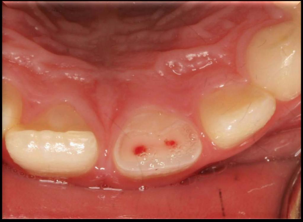 Enamel -Dentin Pulp Fracture