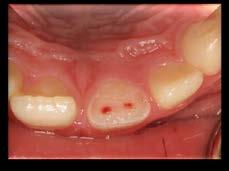 Enamel -Dentin Pulp Fracture (Complicated Crown Fracture) Fracture involves enamel and dentin and the pulp is exposed. Sensibility testing is usually not indicated.