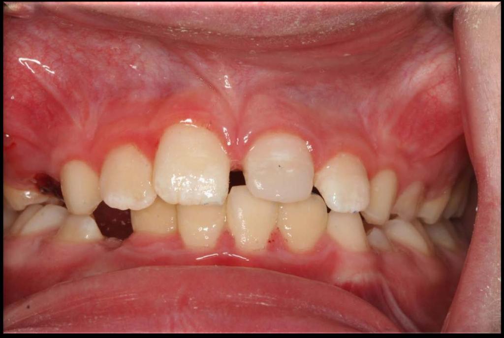 Enamel -Dentin Pulp Fracture (Complicated