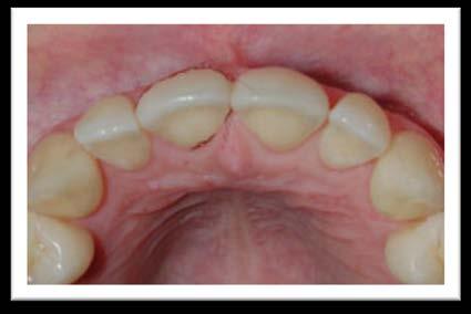 has not been displaced. Bleeding from gingival crevice may be noted. Sensibility testing may be negative initially indicating transient pulpal damage.