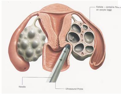 Ovarian stimulation