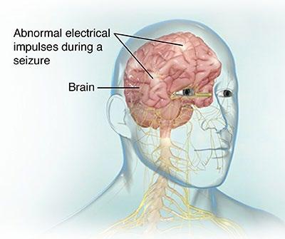Electroencephalography www.hopkinsmedicine.