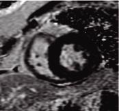 perfusion defect. Findings consistent with stunned myocardium and inducible ischemia. PSIR is used as a fast technique for Delayed Enhancement MRI.