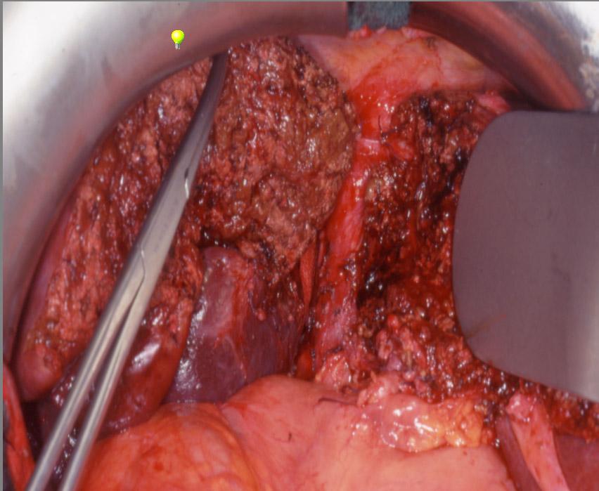 Use of transplantation techniques in liver resections for cancer In situ split Reverse