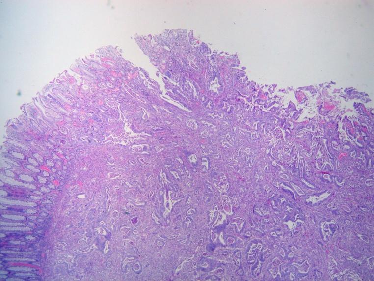 microscopic island of residual adenocarcinoma and one focus of