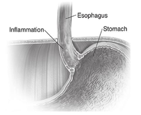 Squamous cell carcinoma: Cancer that forms in squamous cells, the thin, flat cells lining the esophagus.