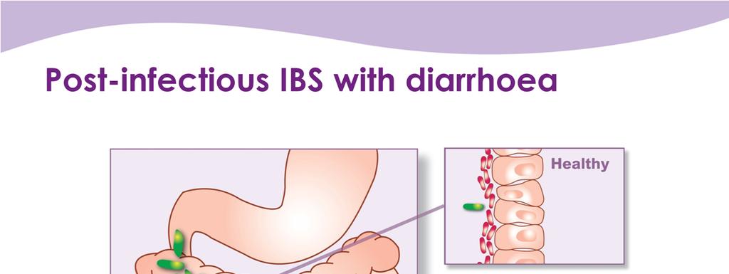 Approximately 17% of IBS patients in the UK have post-infectious IBS; IBS that develops after a specific bout of gastroenteritis.