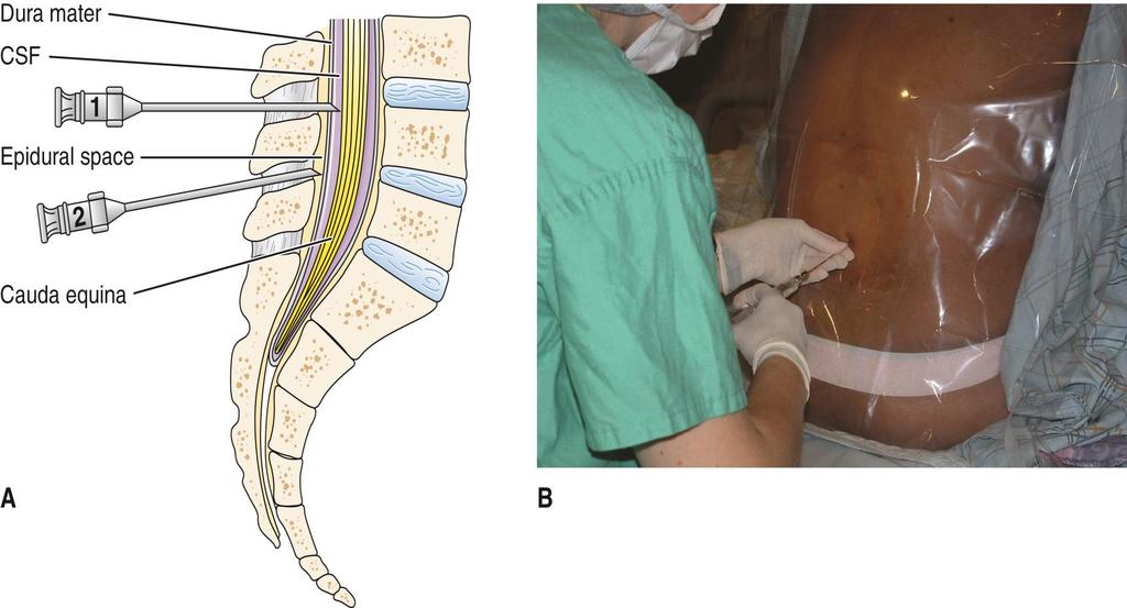 Clinical Aspects of the Spine and Spinal Nerves (cont.