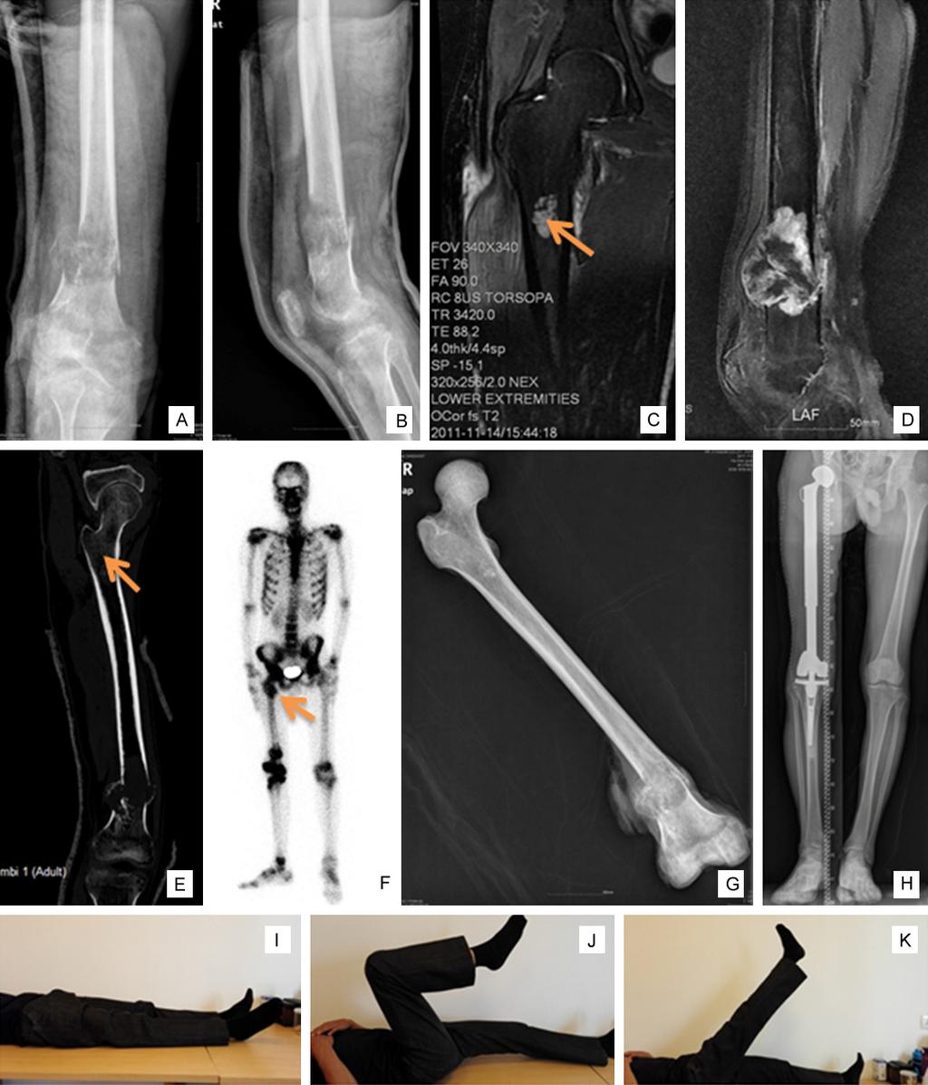 Figure 1. A 33-year-old man with osteosarcoma who sustained sudden pain in right thigh. In X-ray, there was a tumor with pathologic fracture at the distal femur (A, B).